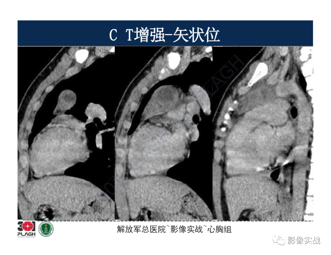影像PPT - 【病例】前纵隔畸胎瘤1例CT影像-12