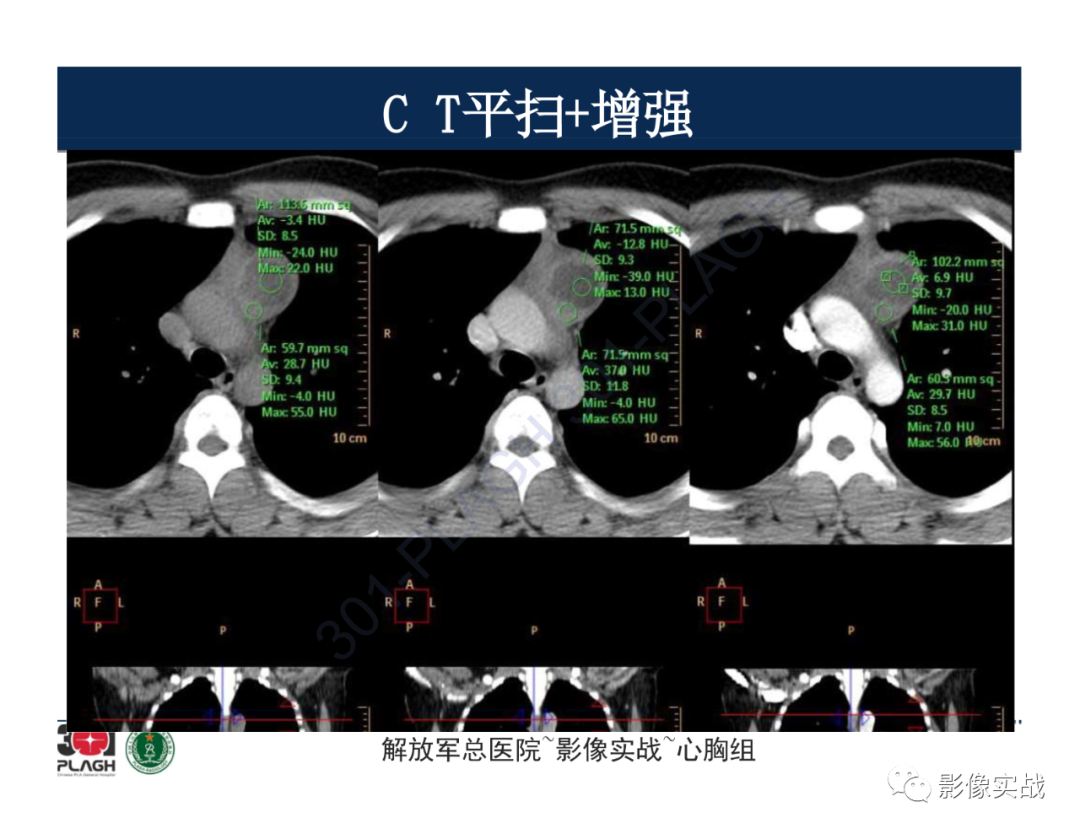影像PPT - 【病例】前纵隔畸胎瘤1例CT影像-13