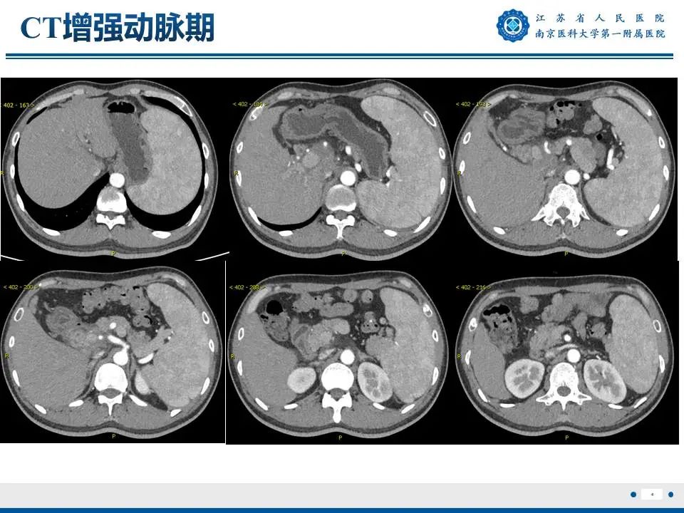 影像PPT - 【PPT】IgG4相关性硬化性胆管炎-5