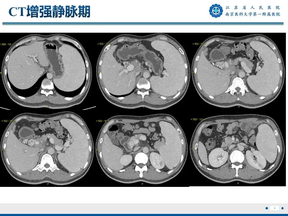 影像PPT - 【PPT】IgG4相关性硬化性胆管炎-6