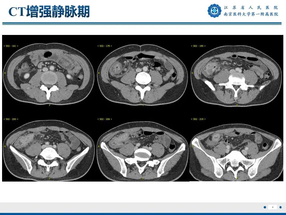 影像PPT - 【PPT】IgG4相关性硬化性胆管炎-7