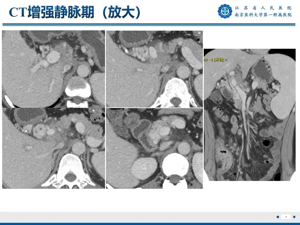影像PPT - 【PPT】IgG4相关性硬化性胆管炎-9