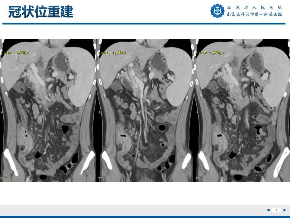 影像PPT - 【PPT】IgG4相关性硬化性胆管炎-8