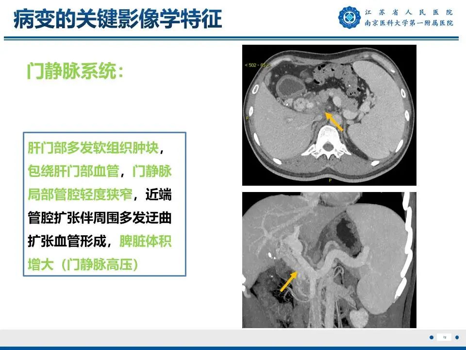 影像PPT - 【PPT】IgG4相关性硬化性胆管炎-13