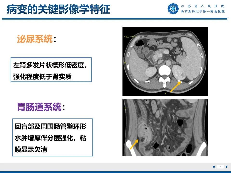 影像PPT - 【PPT】IgG4相关性硬化性胆管炎-14