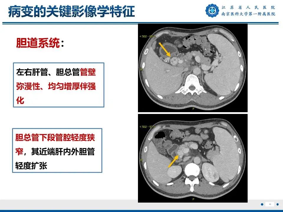 影像PPT - 【PPT】IgG4相关性硬化性胆管炎-12