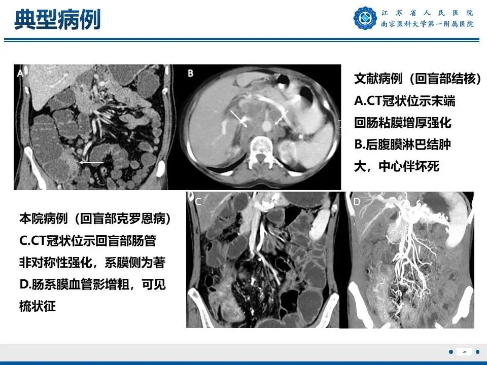 影像PPT - 【PPT】IgG4相关性硬化性胆管炎-25