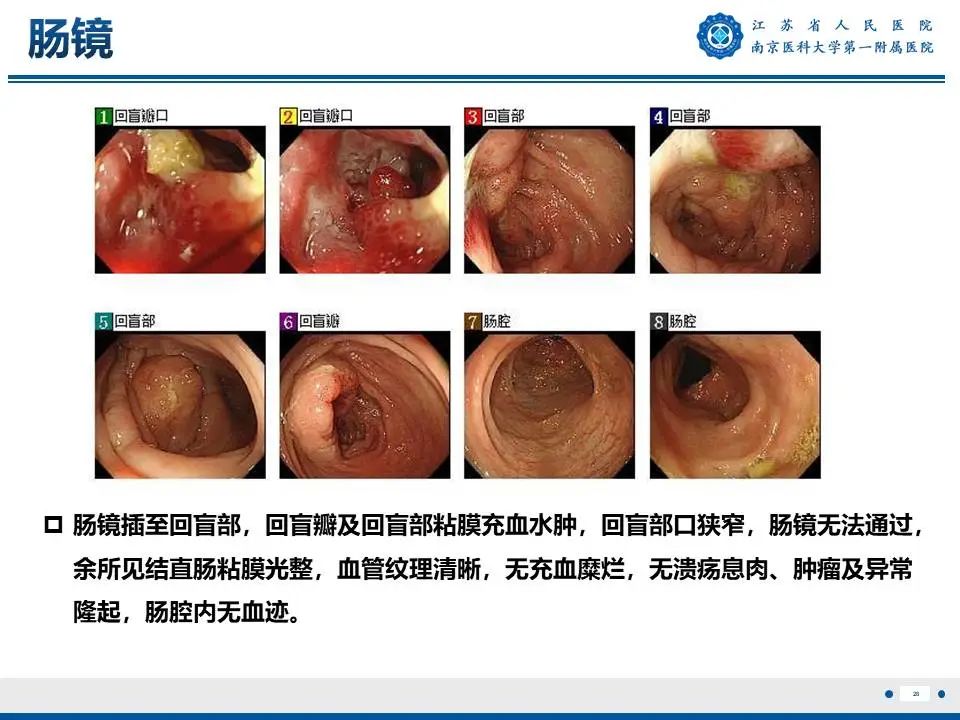 影像PPT - 【PPT】IgG4相关性硬化性胆管炎-29