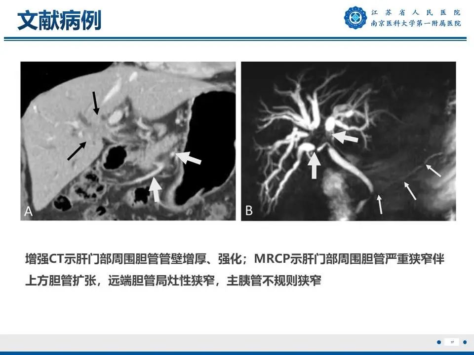 影像PPT - 【PPT】IgG4相关性硬化性胆管炎-38