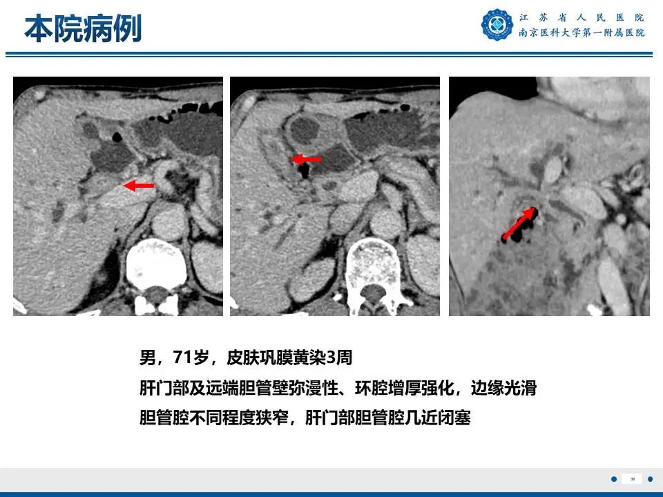 影像PPT - 【PPT】IgG4相关性硬化性胆管炎-37
