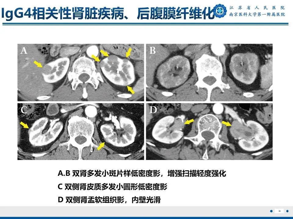 影像PPT - 【PPT】IgG4相关性硬化性胆管炎-41