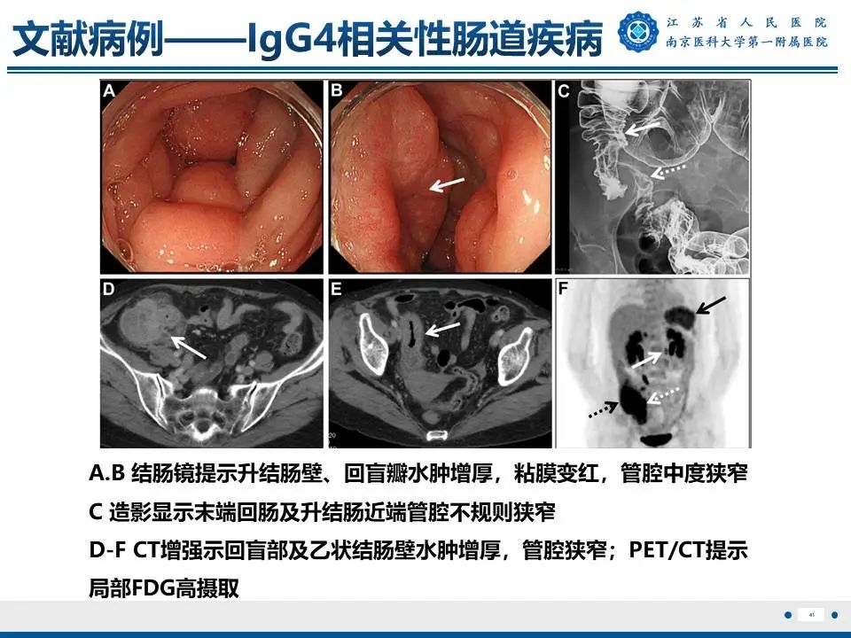影像PPT - 【PPT】IgG4相关性硬化性胆管炎-42