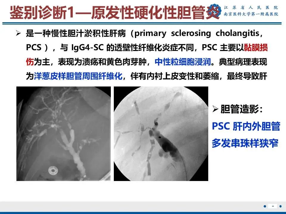 影像PPT - 【PPT】IgG4相关性硬化性胆管炎-45