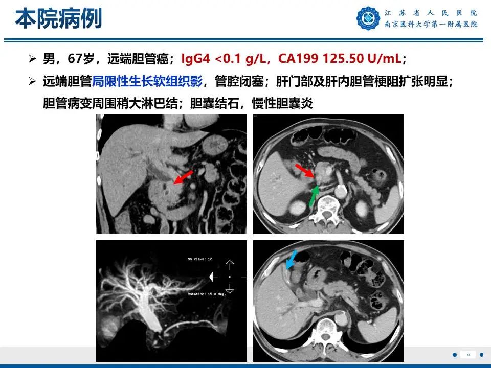 影像PPT - 【PPT】IgG4相关性硬化性胆管炎-48