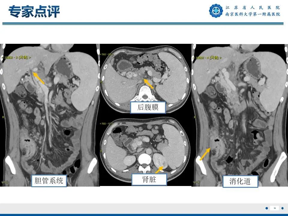 影像PPT - 【PPT】IgG4相关性硬化性胆管炎-53