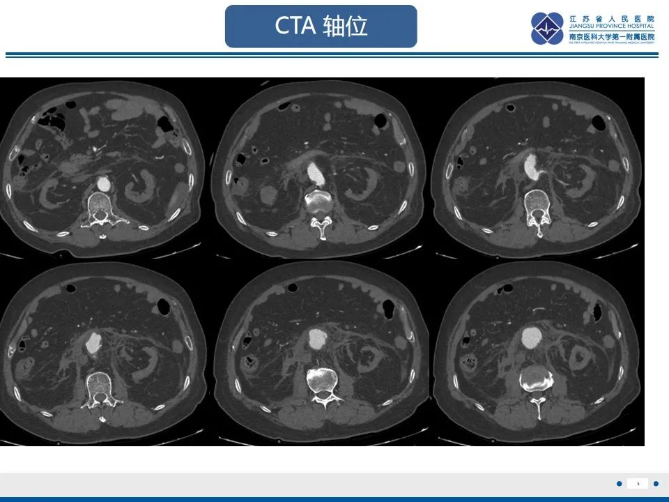 影像PPT - 高度危险的“高密度新月征”-5 影像PPT - 高度危险的“高密度新月征”-5