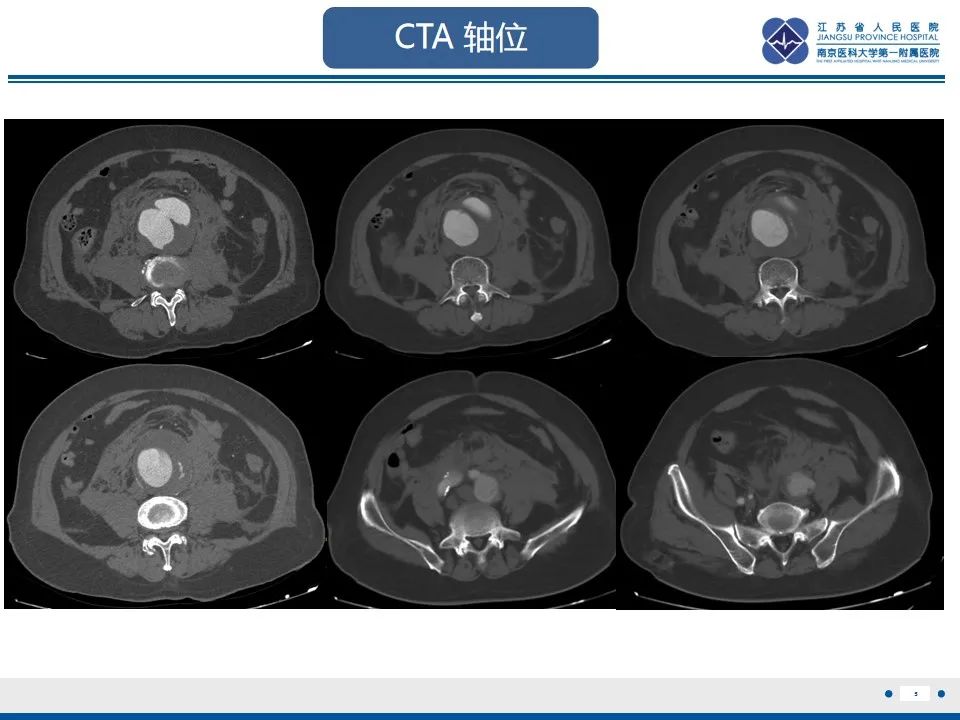 影像PPT - 高度危险的“高密度新月征”-7 影像PPT - 高度危险的“高密度新月征”-7