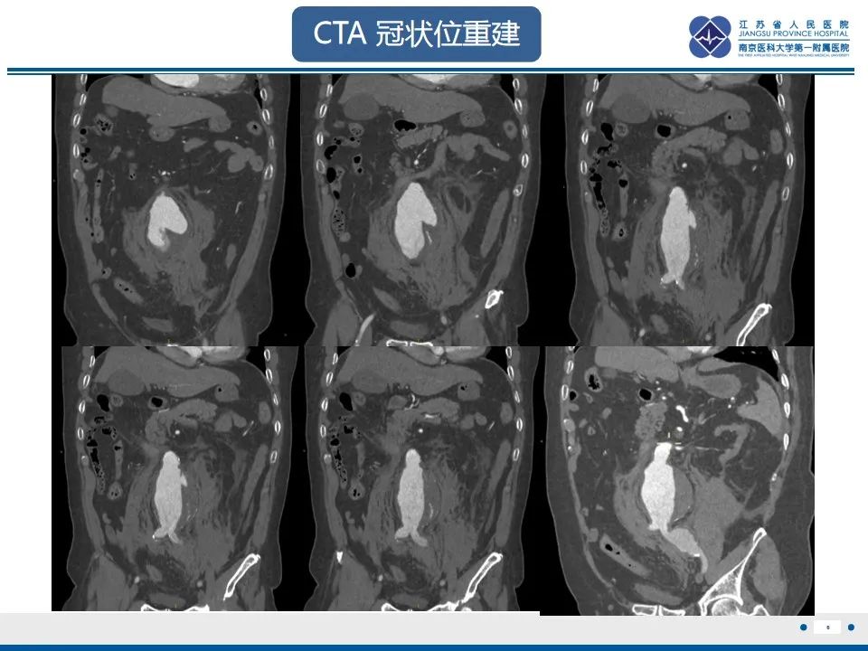 影像PPT - 高度危险的“高密度新月征”-8 影像PPT - 高度危险的“高密度新月征”-8