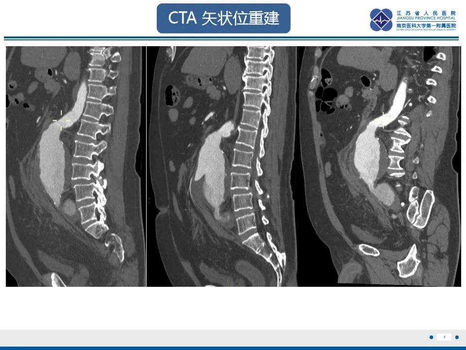 影像PPT - 高度危险的“高密度新月征”-9 影像PPT - 高度危险的“高密度新月征”-9