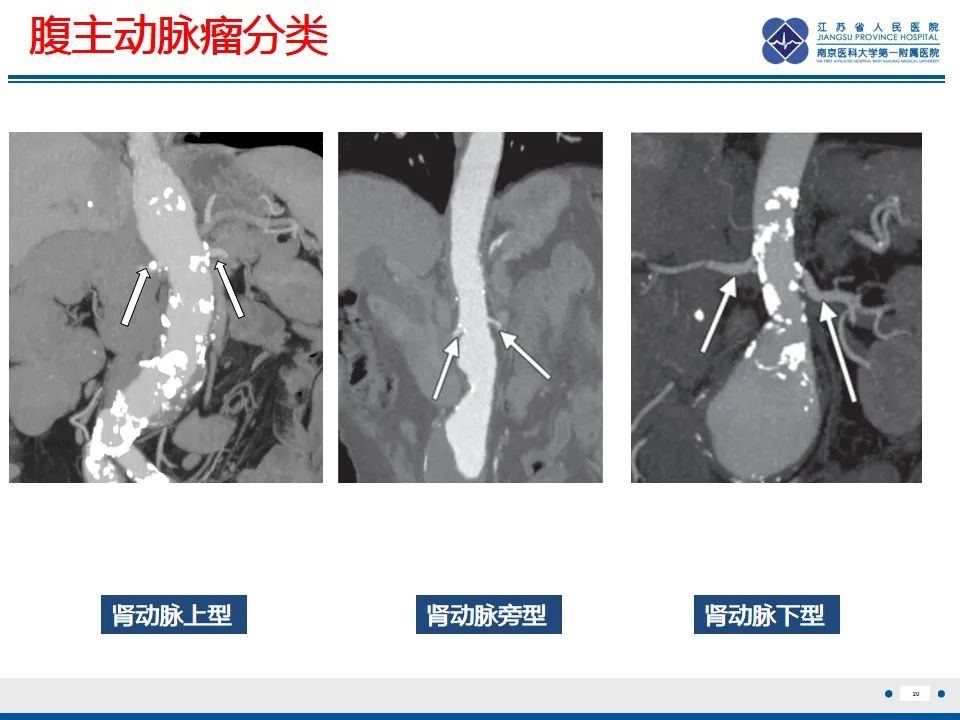 影像PPT - 高度危险的“高密度新月征”-22 影像PPT - 高度危险的“高密度新月征”-22