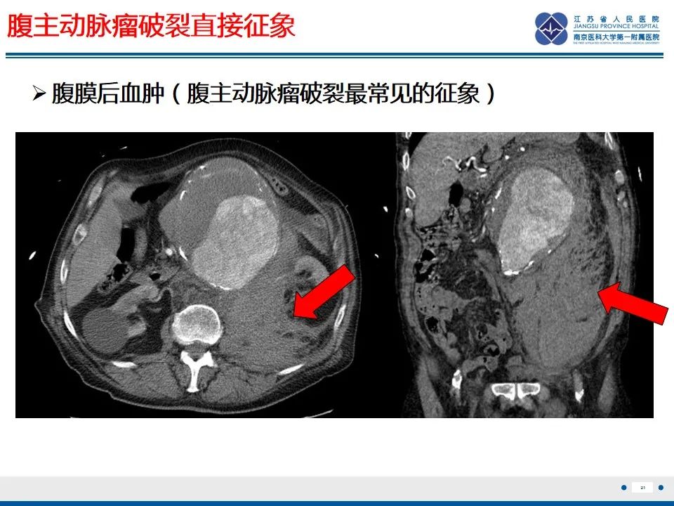 影像PPT - 高度危险的“高密度新月征”-23 影像PPT - 高度危险的“高密度新月征”-23