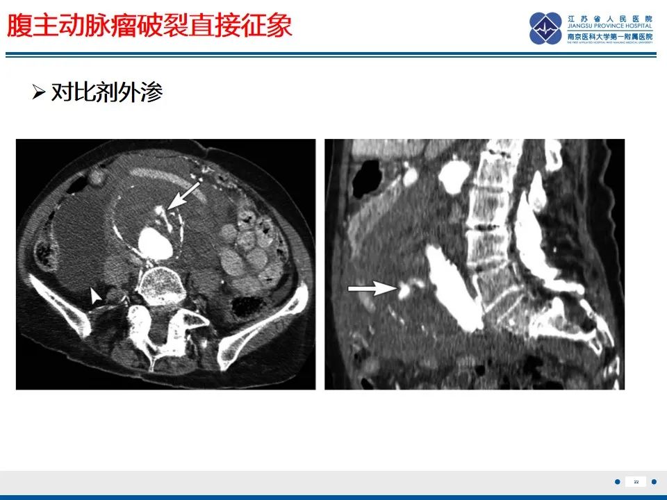 影像PPT - 高度危险的“高密度新月征”-24 影像PPT - 高度危险的“高密度新月征”-24