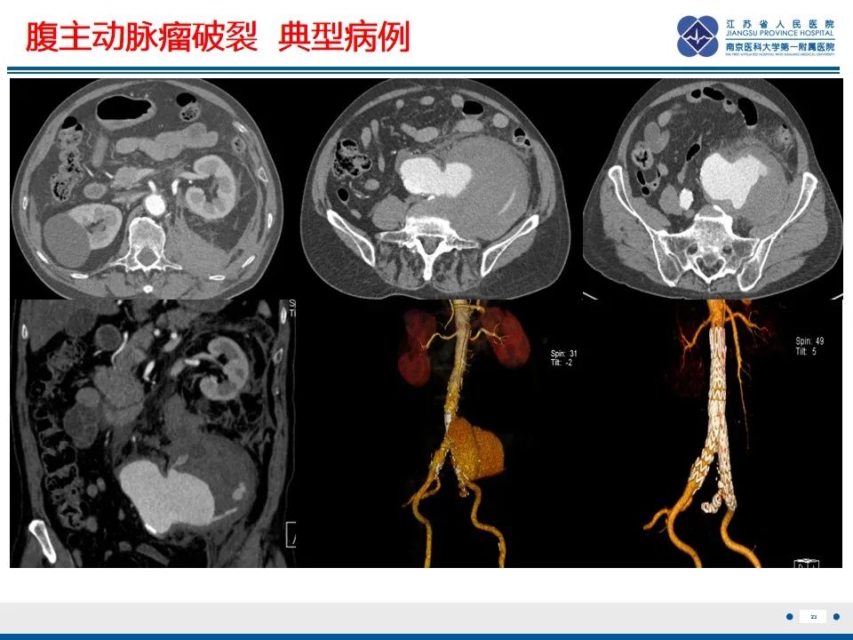 影像PPT - 高度危险的“高密度新月征”-25 影像PPT - 高度危险的“高密度新月征”-25