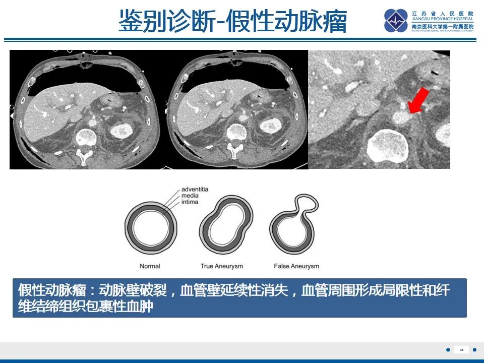 影像PPT - 高度危险的“高密度新月征”-38 影像PPT - 高度危险的“高密度新月征”-38