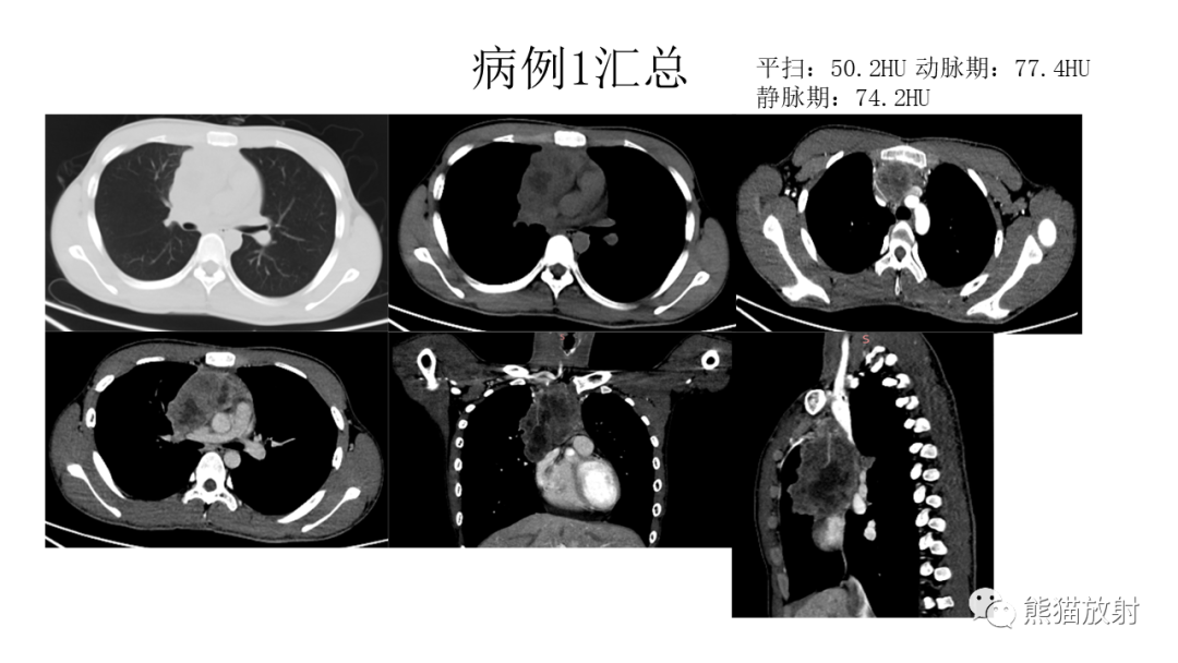 影像PPT - 【病例】胸腺瘤 VS 淋巴瘤-3