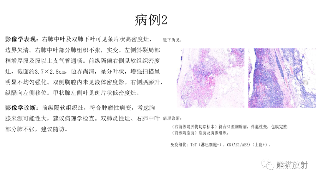 影像PPT - 【病例】胸腺瘤 VS 淋巴瘤-10