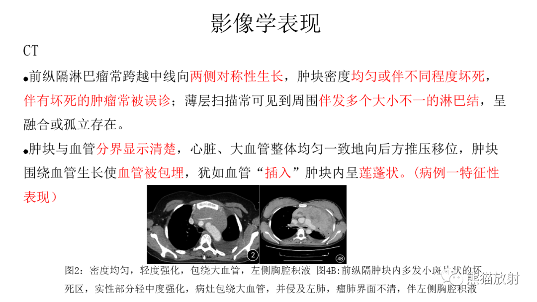 影像PPT - 【病例】胸腺瘤 VS 淋巴瘤-21