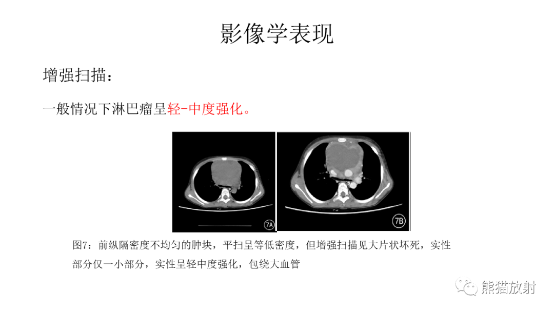 影像PPT - 【病例】胸腺瘤 VS 淋巴瘤-22