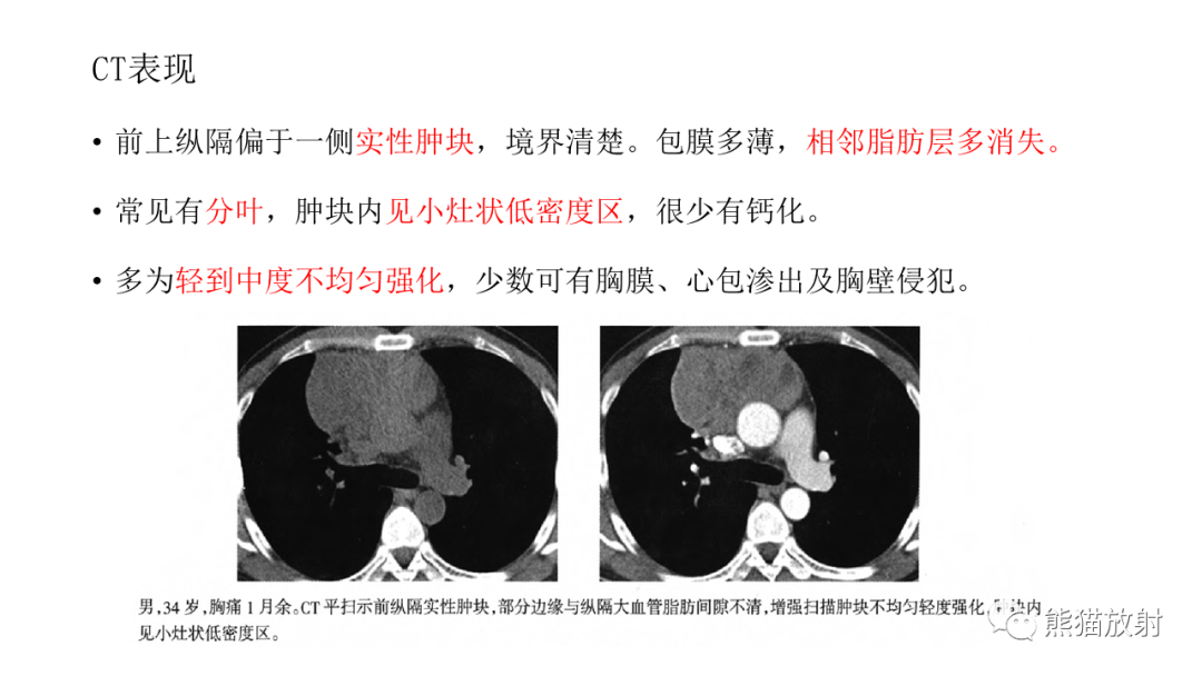 影像PPT - 【病例】胸腺瘤 VS 淋巴瘤-32