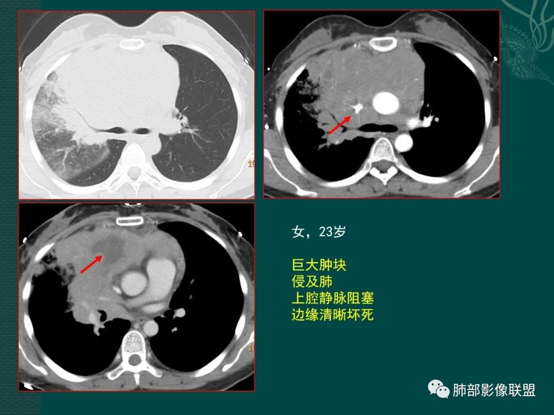 影像PPT - 【病例】胸腺瘤 VS 淋巴瘤-38