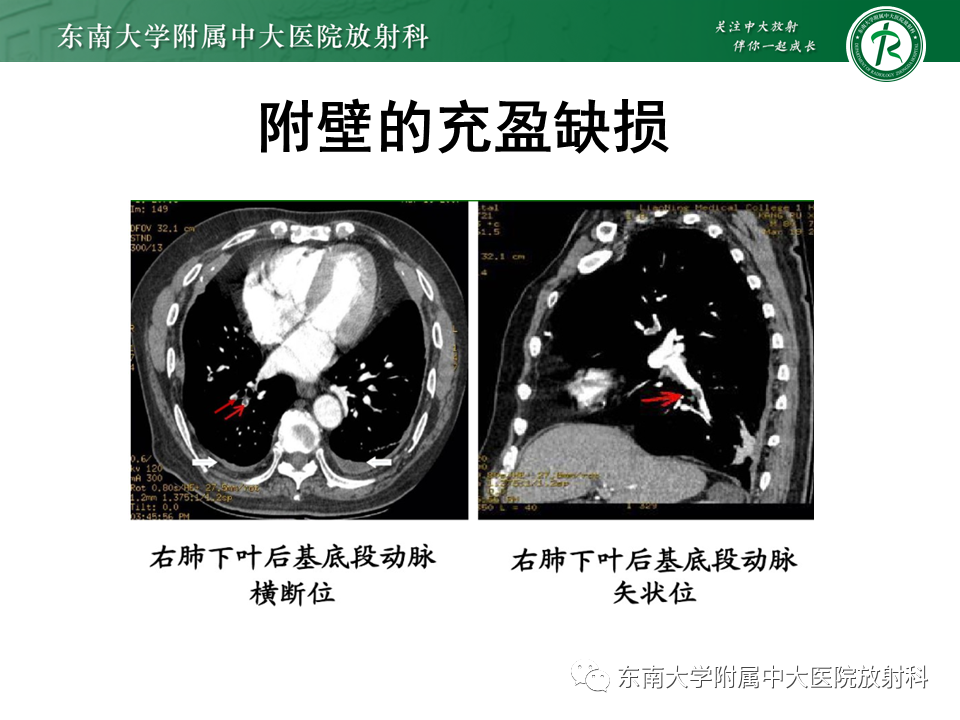 影像PPT - 肺动脉栓塞的“双规征”-10 影像PPT - 肺动脉栓塞的“双规征”-10