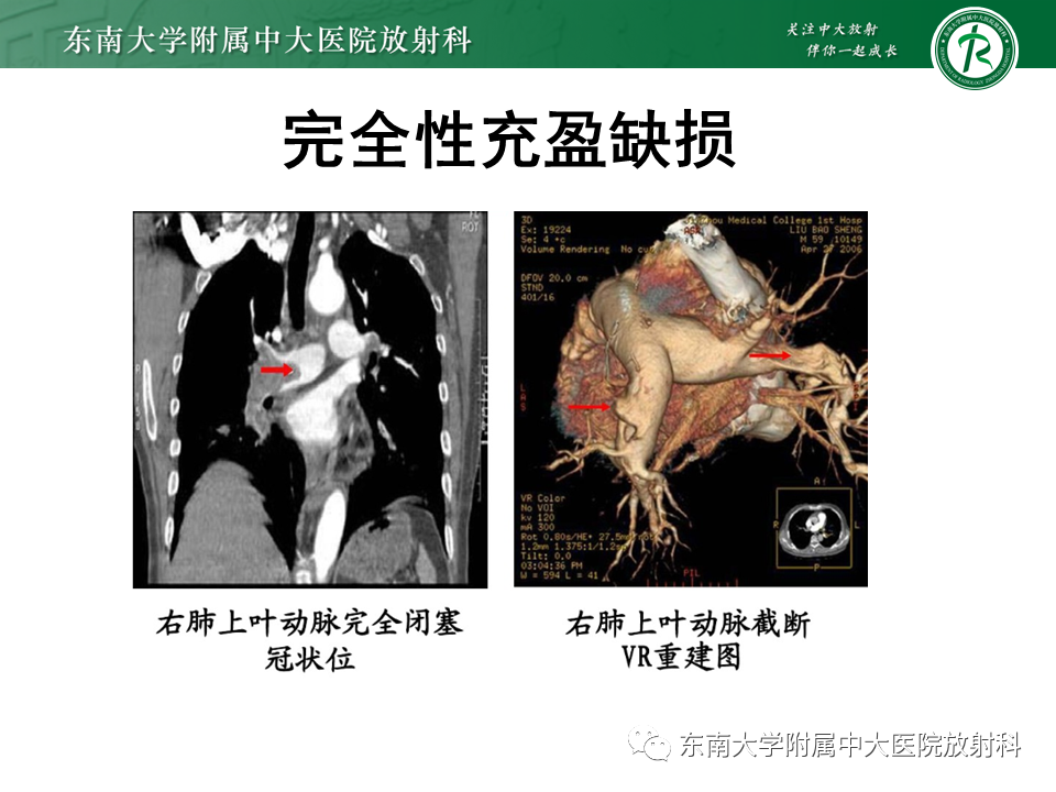 影像PPT - 肺动脉栓塞的“双规征”-11 影像PPT - 肺动脉栓塞的“双规征”-11