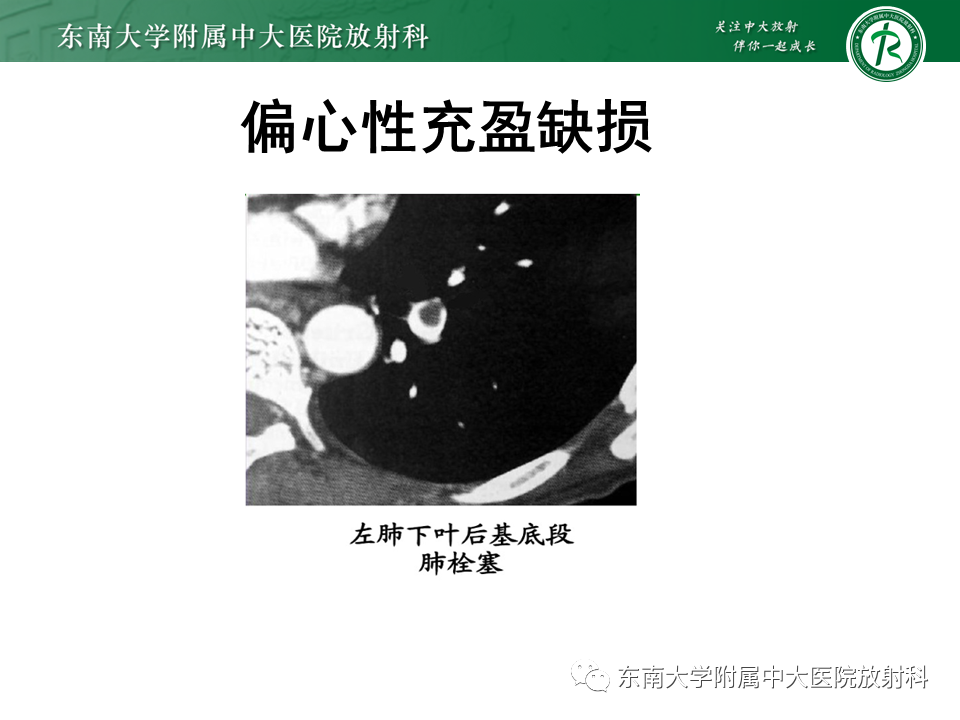 影像PPT - 肺动脉栓塞的“双规征”-9 影像PPT - 肺动脉栓塞的“双规征”-9