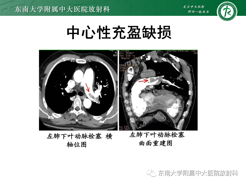 影像PPT - 肺动脉栓塞的“双规征”-8 影像PPT - 肺动脉栓塞的“双规征”-8