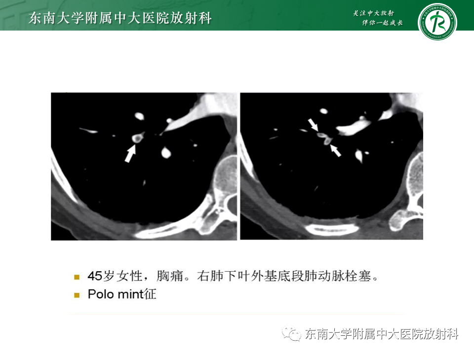 影像PPT - 肺动脉栓塞的“双规征”-12 影像PPT - 肺动脉栓塞的“双规征”-12