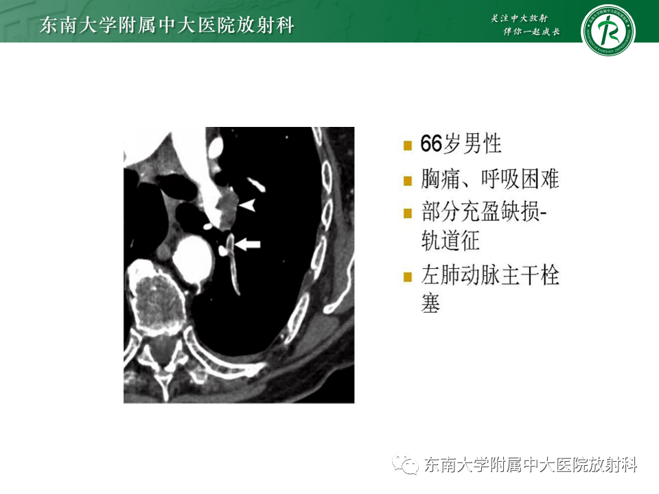 影像PPT - 肺动脉栓塞的“双规征”-13 影像PPT - 肺动脉栓塞的“双规征”-13