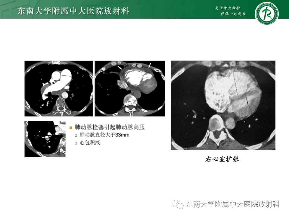 影像PPT - 肺动脉栓塞的“双规征”-15 影像PPT - 肺动脉栓塞的“双规征”-15