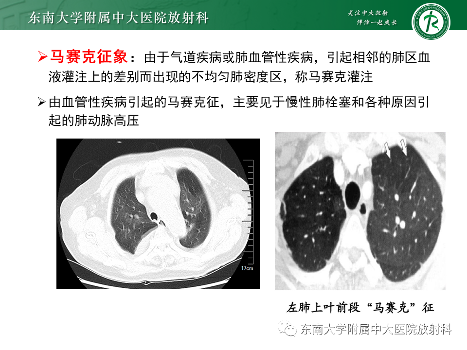 影像PPT - 肺动脉栓塞的“双规征”-16 影像PPT - 肺动脉栓塞的“双规征”-16