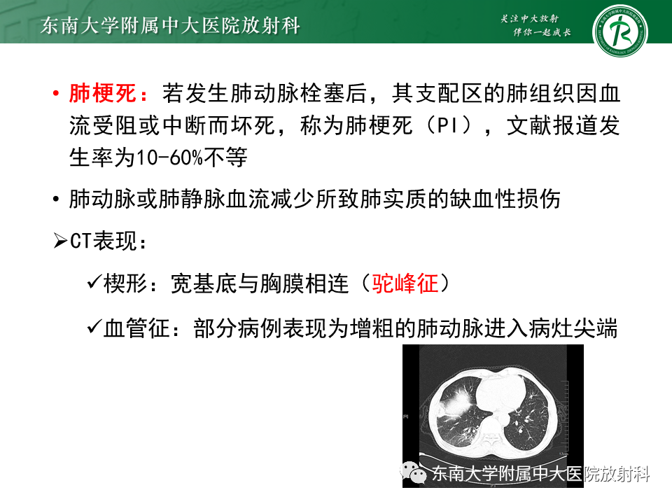 影像PPT - 肺动脉栓塞的“双规征”-17 影像PPT - 肺动脉栓塞的“双规征”-17