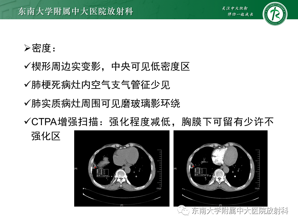 影像PPT - 肺动脉栓塞的“双规征”-18 影像PPT - 肺动脉栓塞的“双规征”-18