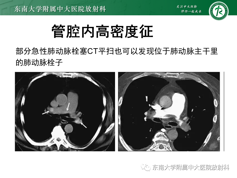 影像PPT - 肺动脉栓塞的“双规征”-19 影像PPT - 肺动脉栓塞的“双规征”-19
