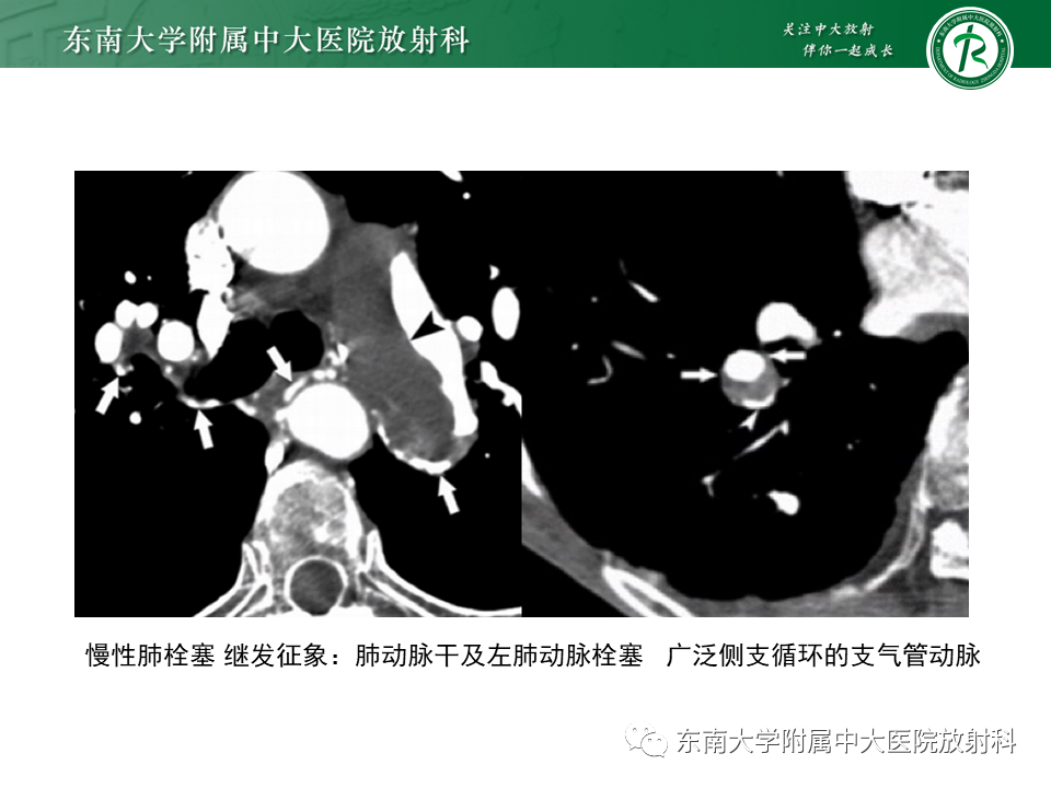 影像PPT - 肺动脉栓塞的“双规征”-21 影像PPT - 肺动脉栓塞的“双规征”-21