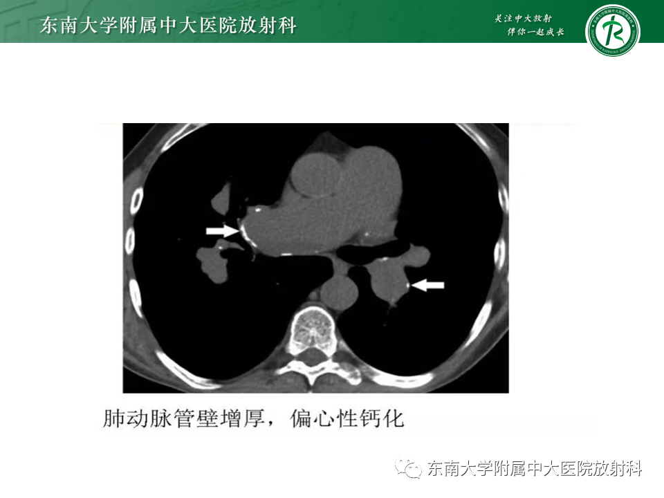 影像PPT - 肺动脉栓塞的“双规征”-22 影像PPT - 肺动脉栓塞的“双规征”-22