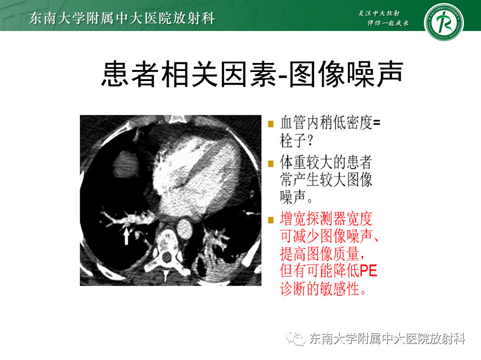 影像PPT - 肺动脉栓塞的“双规征”-24 影像PPT - 肺动脉栓塞的“双规征”-24