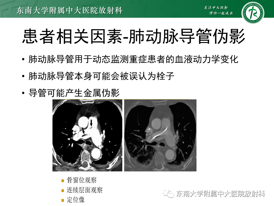 影像PPT - 肺动脉栓塞的“双规征”-25 影像PPT - 肺动脉栓塞的“双规征”-25