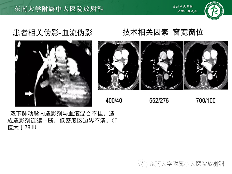 影像PPT - 肺动脉栓塞的“双规征”-26 影像PPT - 肺动脉栓塞的“双规征”-26